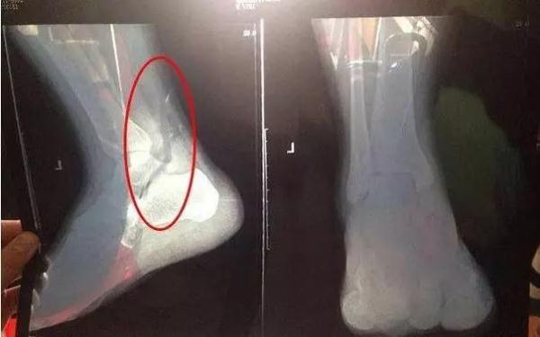 抖腿是病，还是毛病？有人把自己抖进了医院？吓得我赶紧摁住了腿……